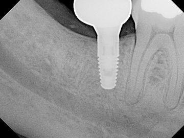X ray of dental implant