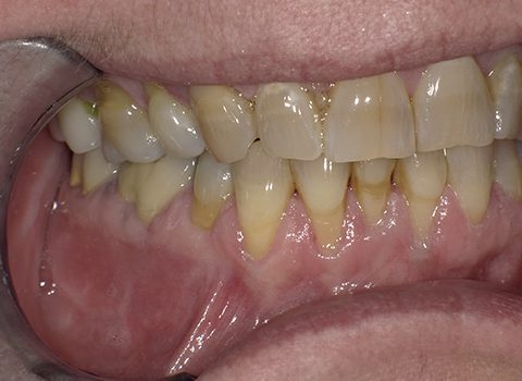 Gum Disease Pinhole Technique